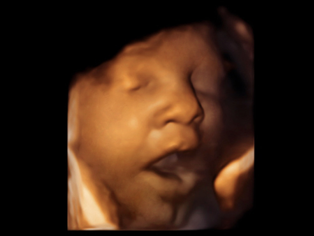 3D Ultraschall 35. SSW
